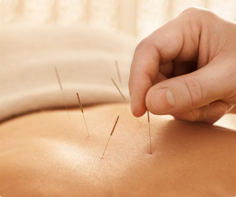 Akupunktur behandling