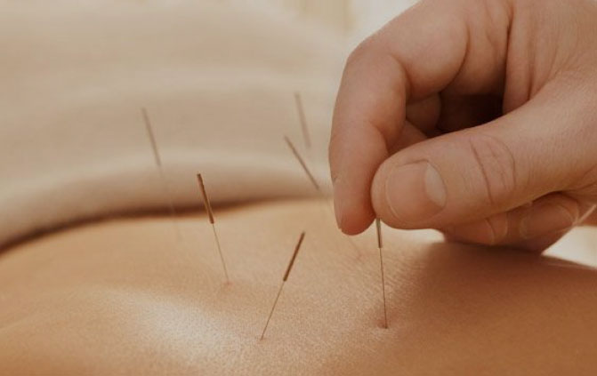 Akupunktur